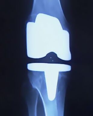 Picture X-Ray du genou avec une prothèse artificielle après l'opération pour changer l'articulation