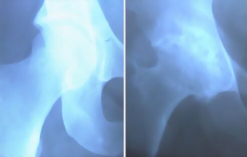 Écume de l'arthrose de l'articulation du genou