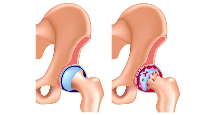 articulation de la hanche saine et atteinte d'arthrose