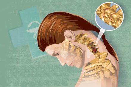 Symptômes réflexes de l'ostéochondrose